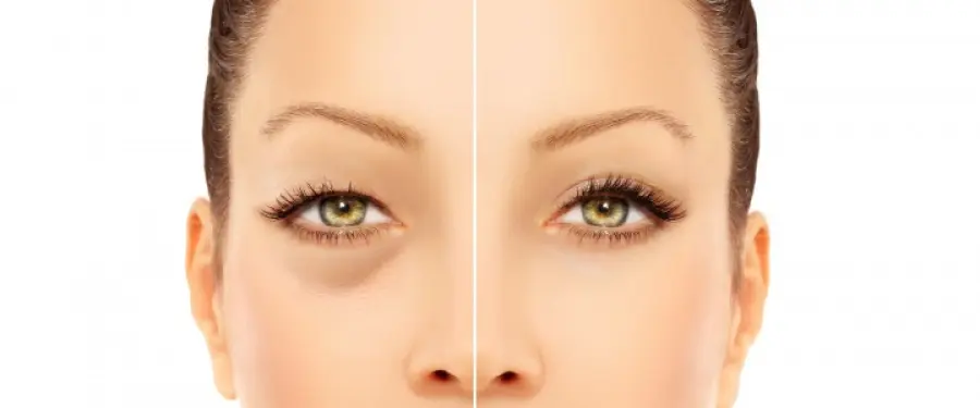 Blefaroplastica a Firenze: consigli utili