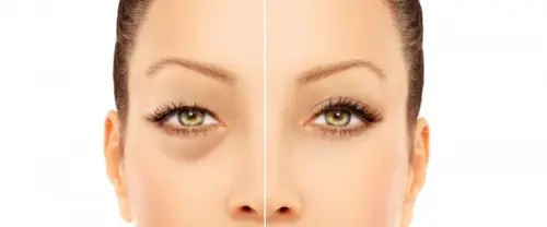 Blefaroplastica a Firenze: consigli utili