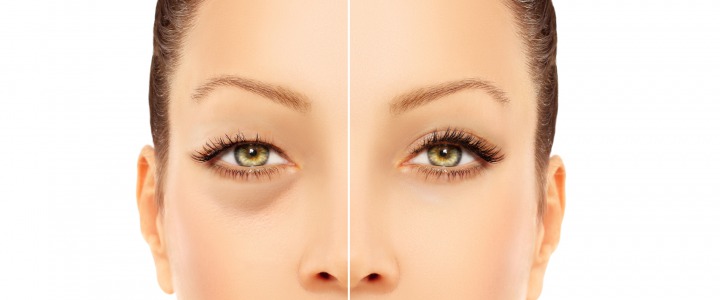 Blefaroplastica a Firenze: consigli utili
